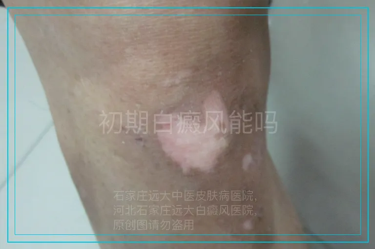 初期白癜风能吗