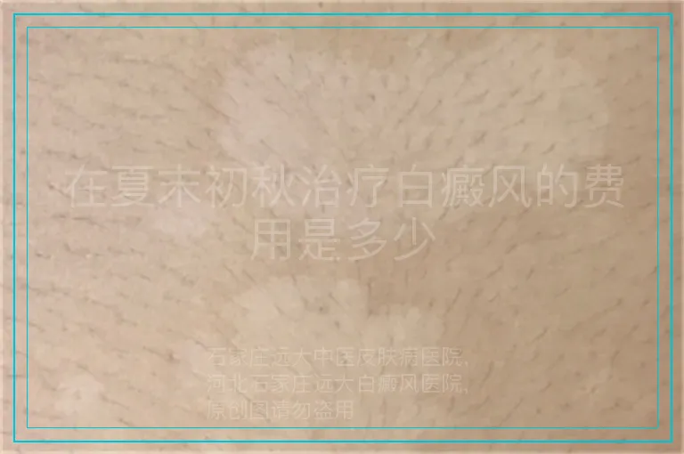 在夏末初秋治疗白癜风的费用是多少