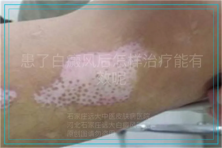 患了白癜风后怎样治疗能有效呢