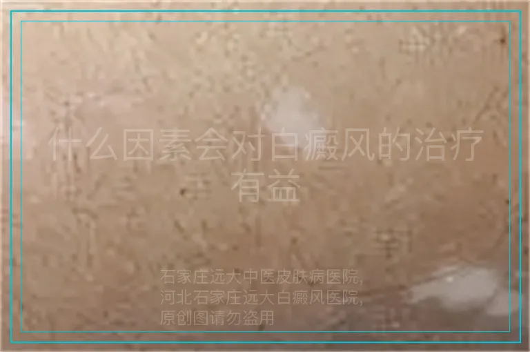什么因素会对白癜风的治疗有益