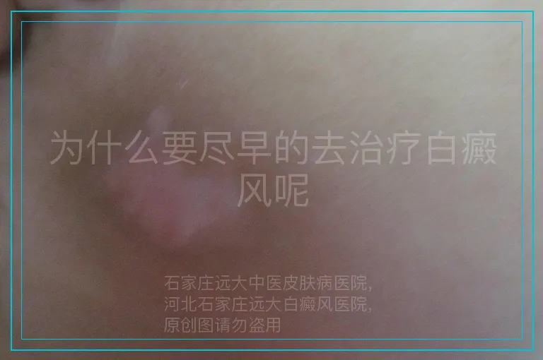 为什么要尽早的去治疗白癜风呢