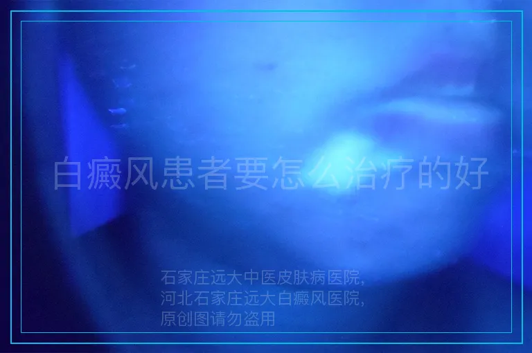 白癜风患者要怎么治疗的好