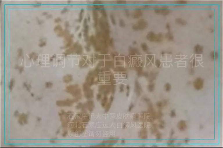 心理调节对于白癜风患者很重要