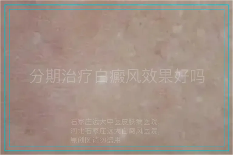分期治疗白癜风效果好吗