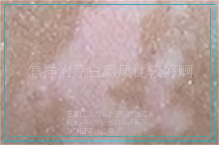 怎样治疗白癜风比较好啊