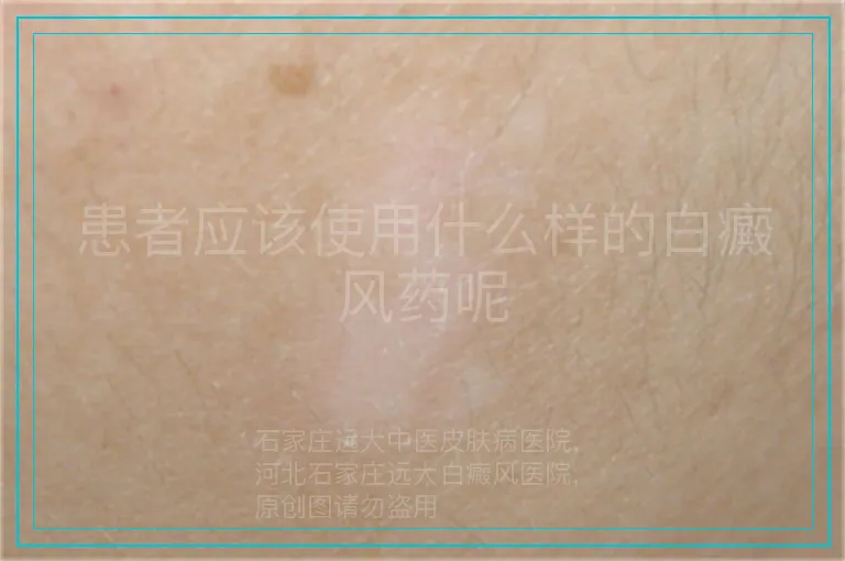 患者应该使用什么样的白癜风药呢