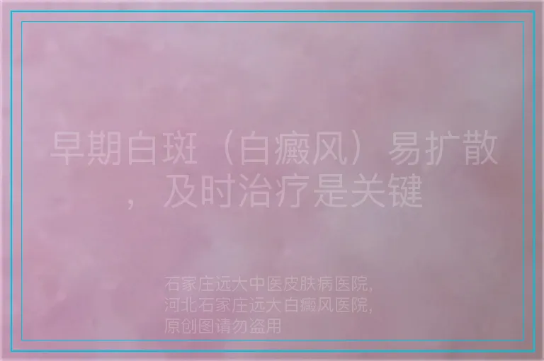早期白斑(白癜风)易扩散,及时治疗是关键