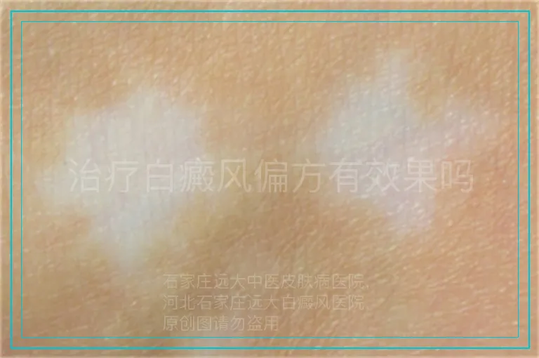 治疗白癜风偏方有效果吗