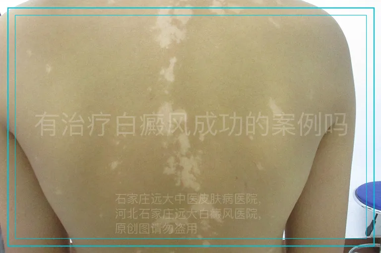 有治疗白癜风成功的案例吗