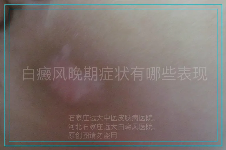 白癜风晚期症状有哪些表现