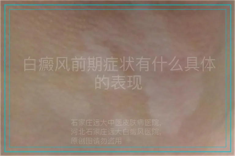 白癜风前期症状有什么具体的表现