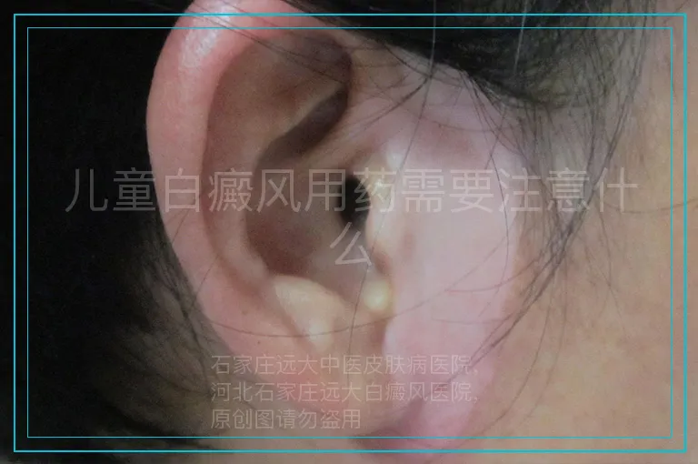 儿童白癜风用药需要注意什么