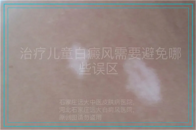  治疗儿童白癜风需要避免哪些误区