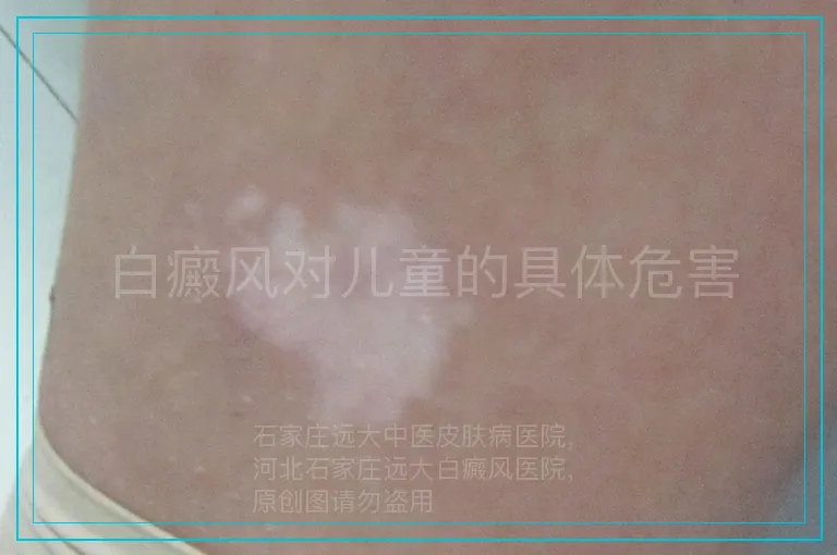 白癜风对儿童的具体危害