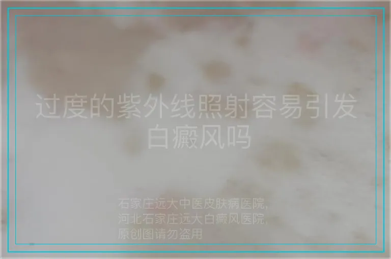 过度的紫外线照射容易引发白癜风吗
