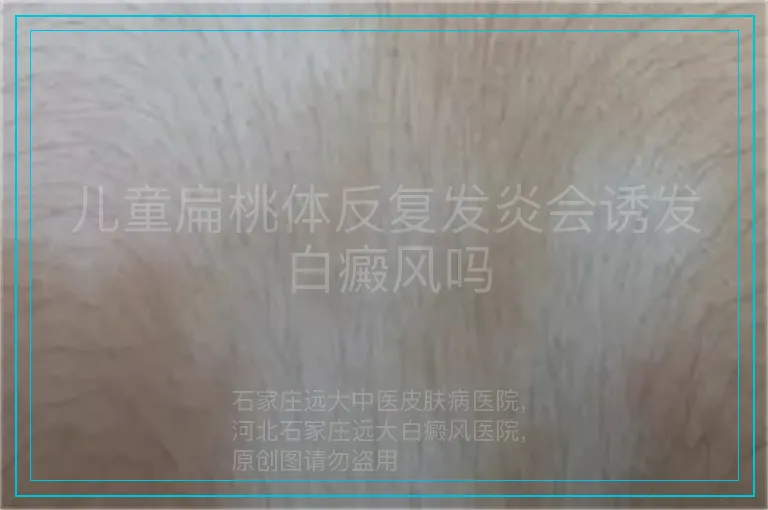 儿童扁桃体反复发炎会诱发白癜风吗