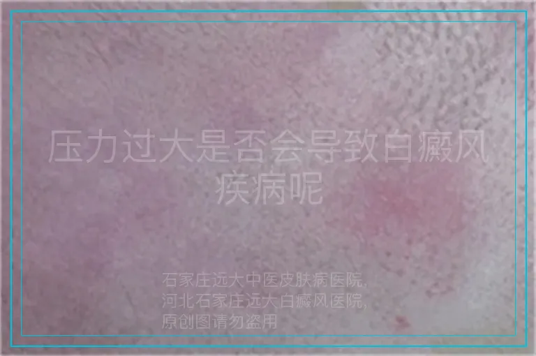 压力过大是否会导致白癜风疾病呢