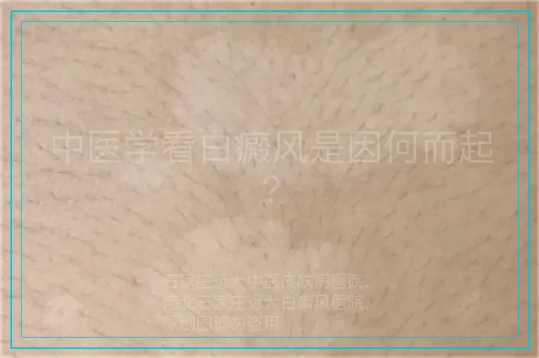 中医学看白癜风是因何而起?