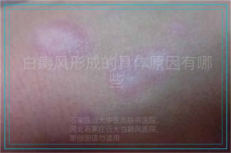 白癜风形成的具体原因有哪些