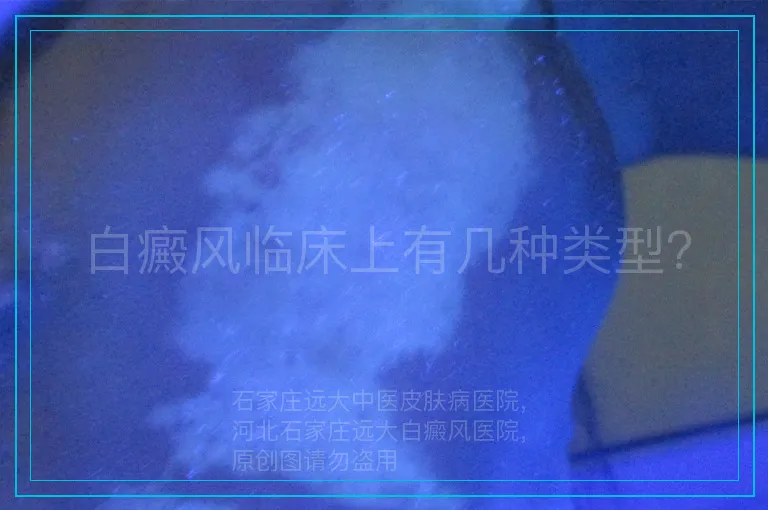 白癜风临床上有几种类型？