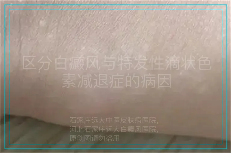 区分白癜风与特发性滴状色素减退症的病因