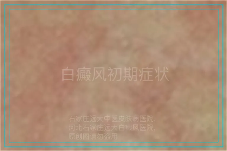 白癜风初期症状