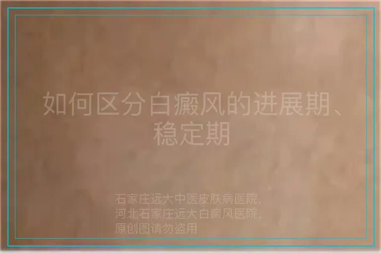 如何区分白癜风的进展期、稳定期