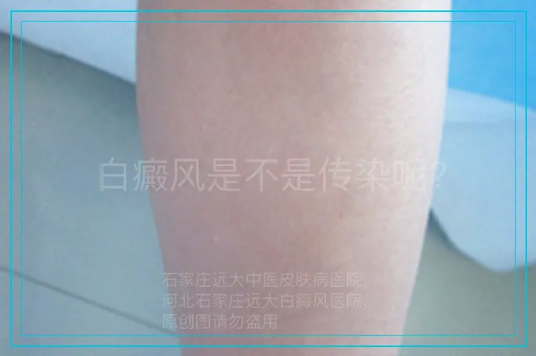 白癜风是不是传染呢?