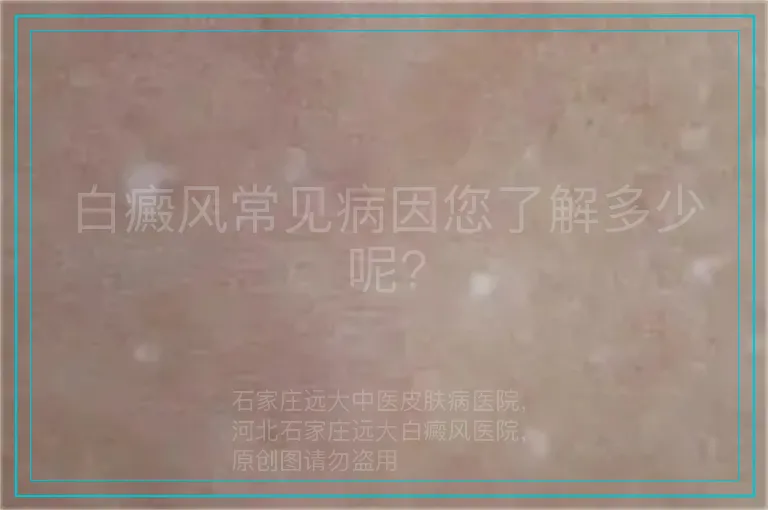白癜风常见病因您了解多少呢?