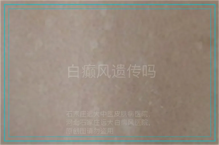 白癫风遗传吗