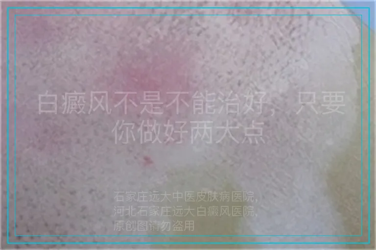 白癜风不是不能治好,只要你做好两大点