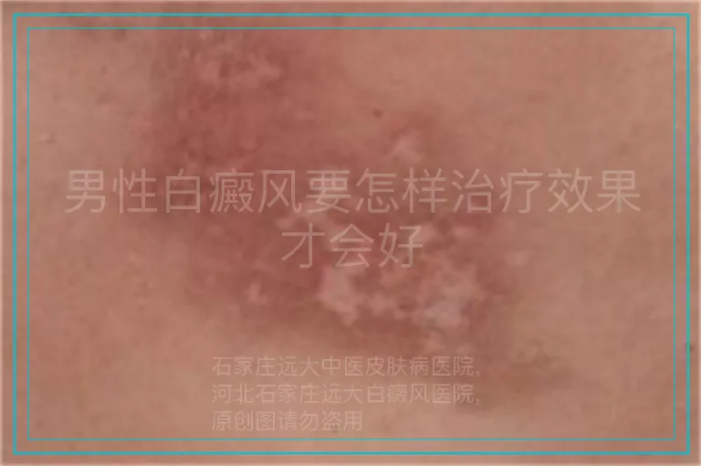 男性白癜风要怎样治疗效果才会好