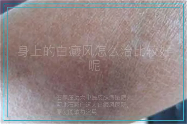 身上的白癜风怎么治比较好呢