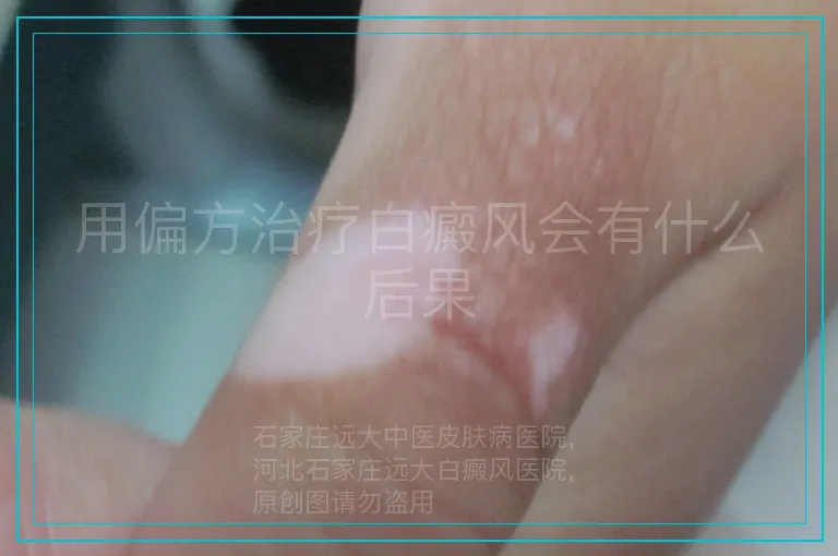 用偏方治疗白癜风会有什么后果