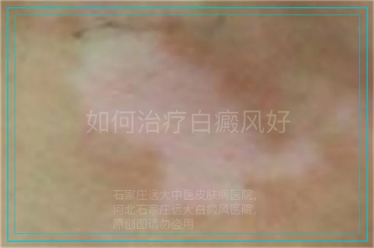 如何治疗白癜风好