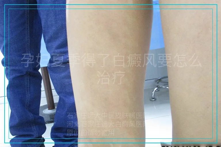 孕妇夏季得了白癜风要怎么治疗