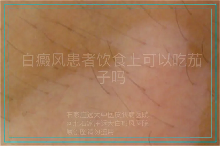 白癜风患者饮食上可以吃茄子吗