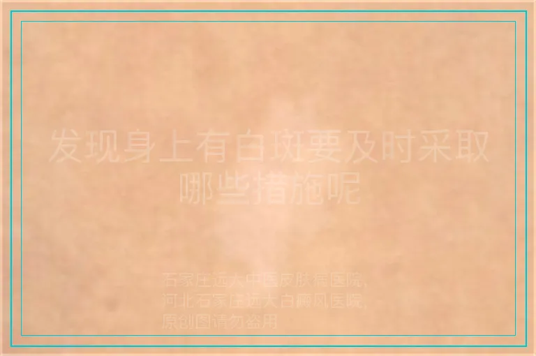 发现身上有白斑要及时采取哪些措施呢