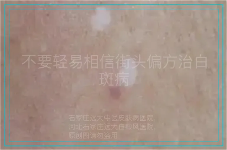 不要轻易相信街头偏方治白斑病