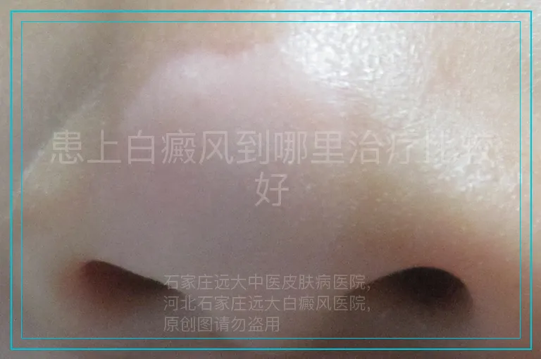 患上白癜风到哪里治疗比较好