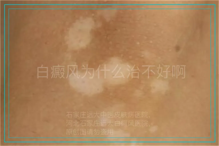 白癜风为什么治不好啊