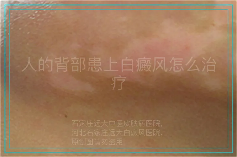 人的背部患上白癜风怎么治疗