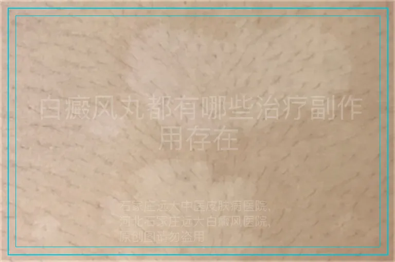 白癜风丸都有哪些治疗副作用存在
