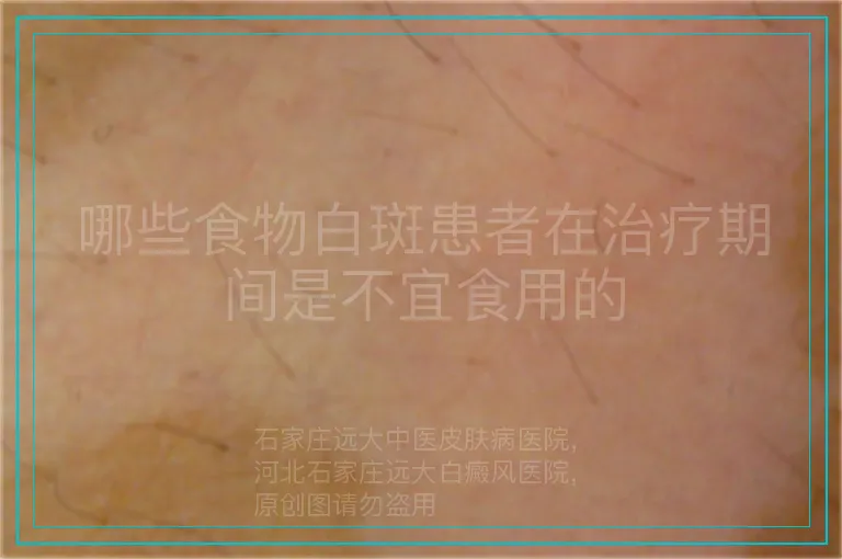 哪些食物白斑患者在治疗期间是不宜食用的