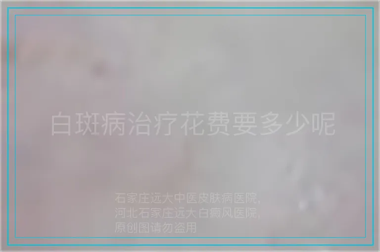 白斑病治疗花费要多少呢