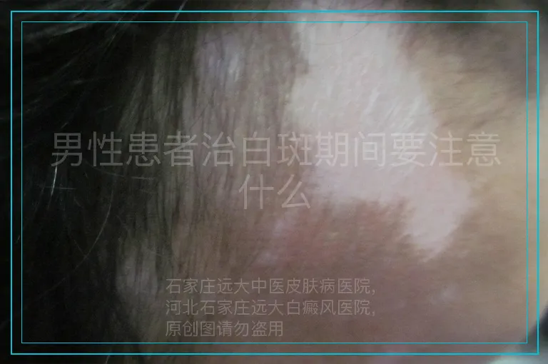 男性患者治白斑期间要注意什么