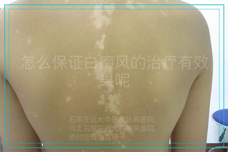 怎么保证白癜风的治疗有效果呢
