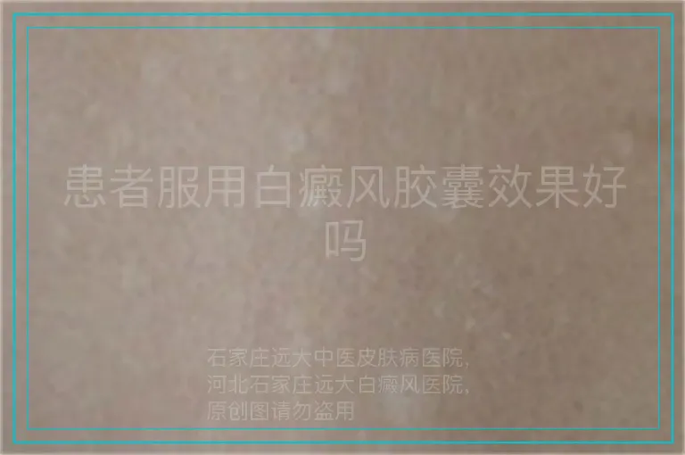 患者服用白癜风胶囊效果好吗