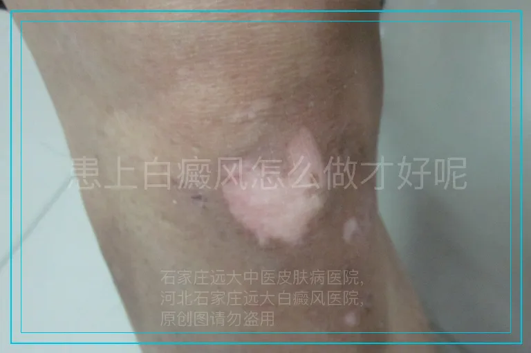 患上白癜风怎么做才好呢