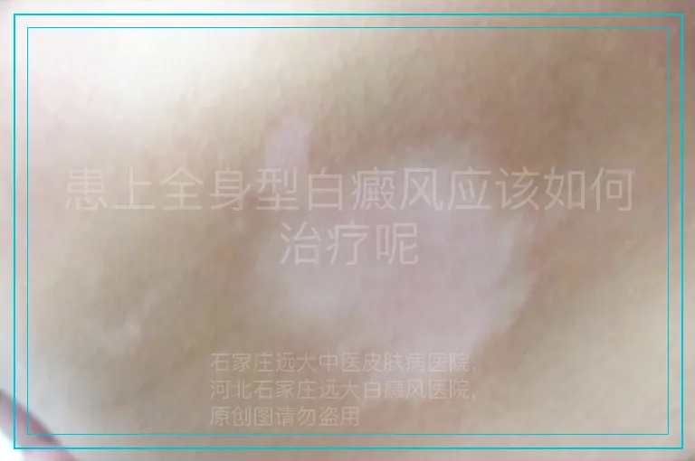 患上全身型白癜风应该如何治疗呢
